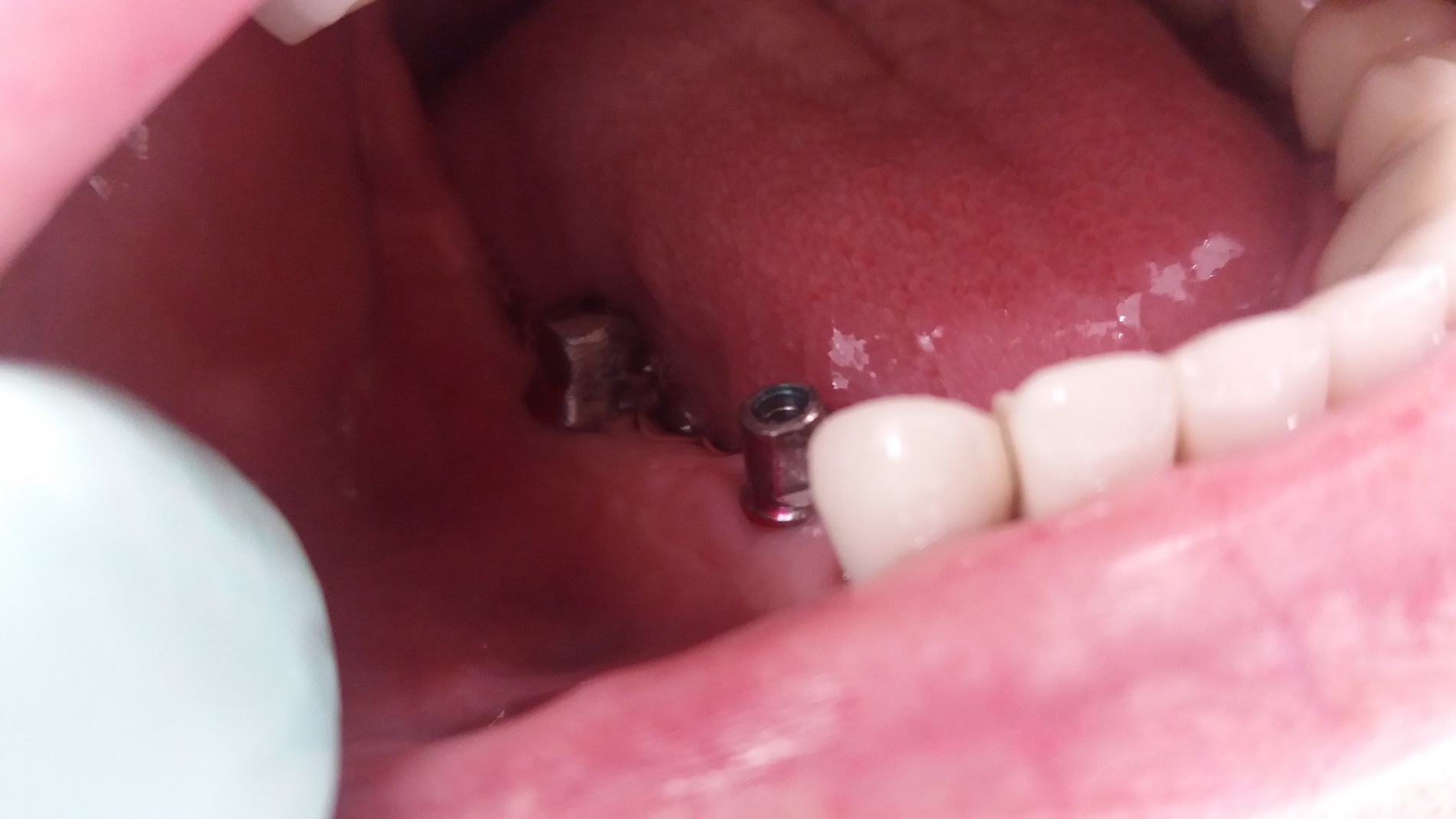patient no.2: Lateral bridge of 4 members on 2 implants-Before