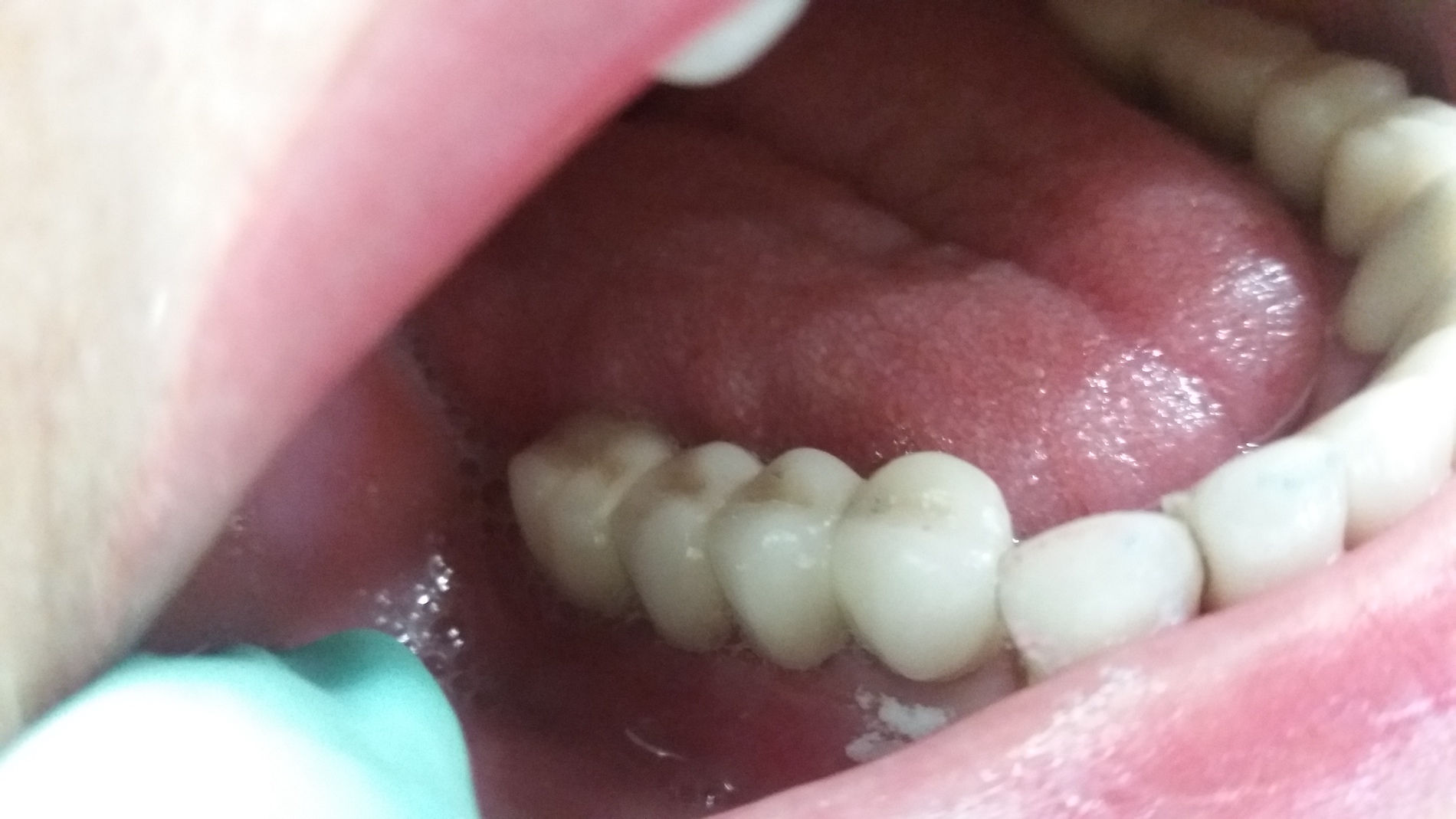 patient no.2: Lateral bridge of 4 members on 2 implants-After
