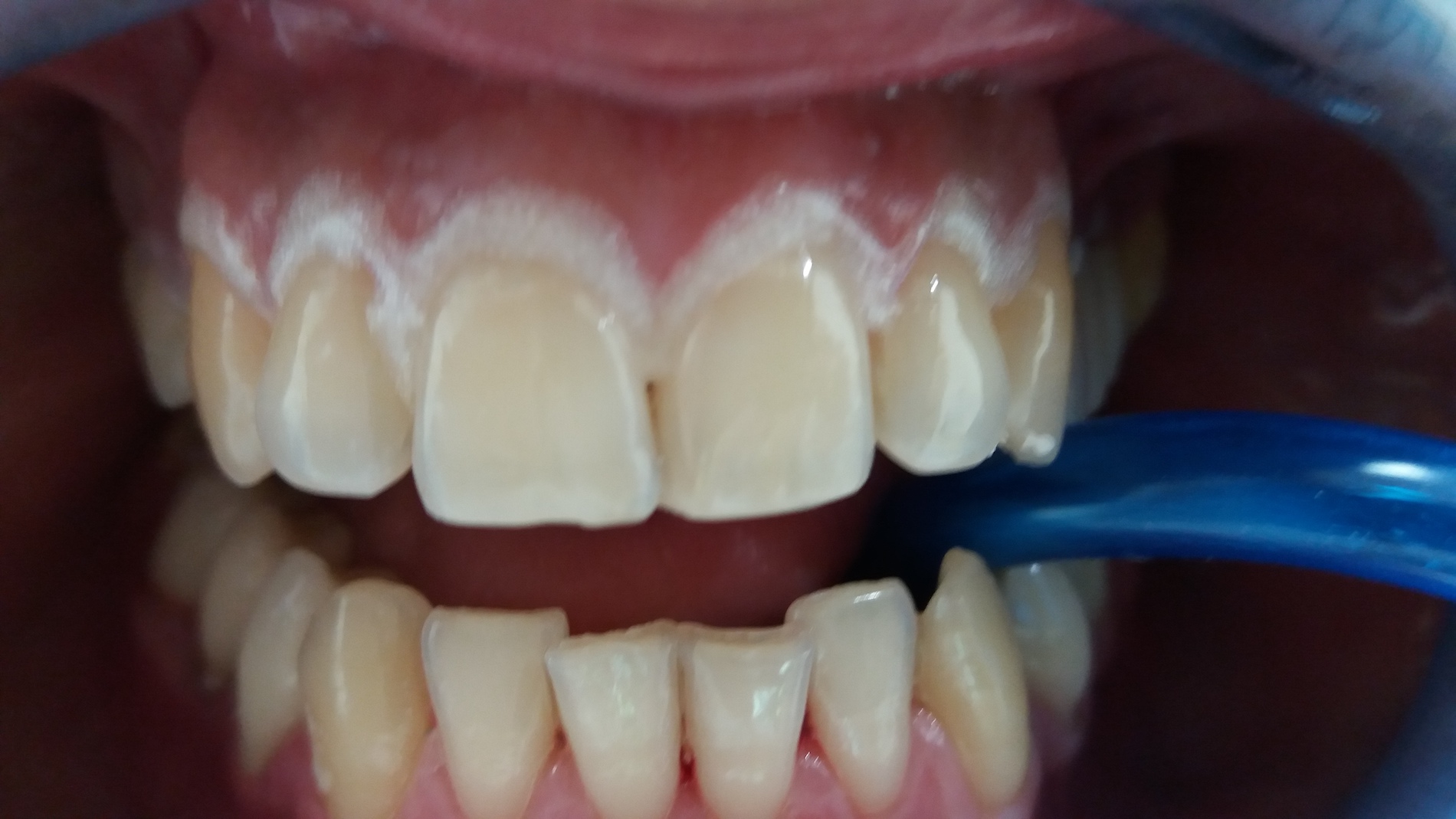 patient no.3: Teeth whitening-Before