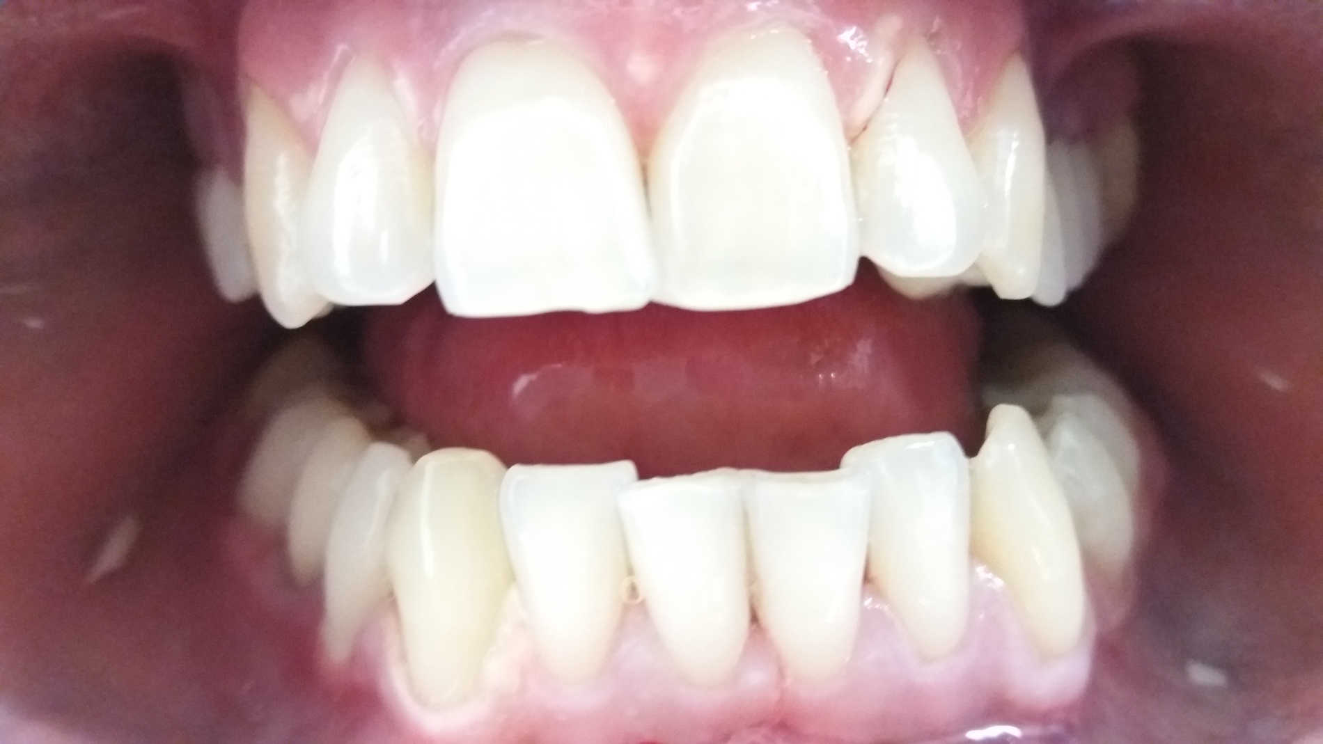 patient no.3: Teeth whitening-After