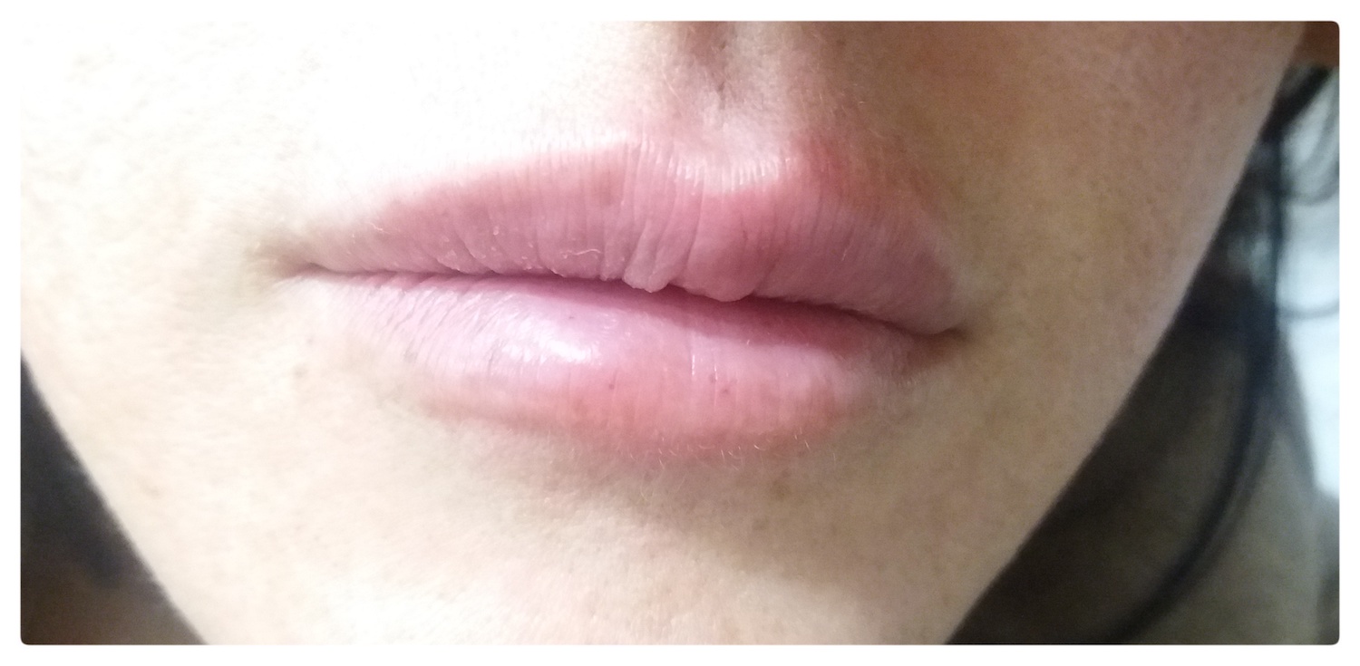 Patient No.1: Lip application- Before