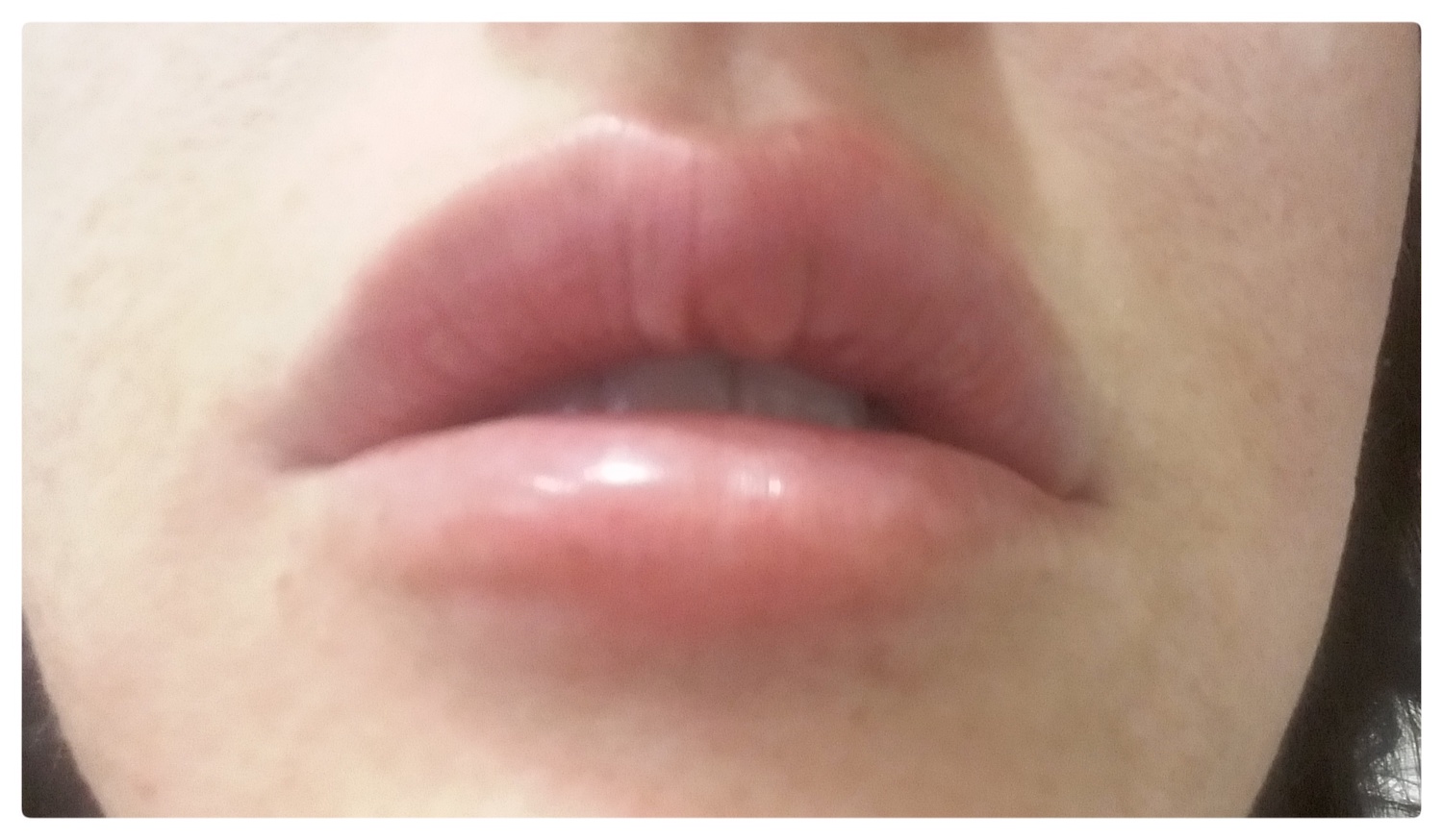 Patient No.1: Lip application-Before