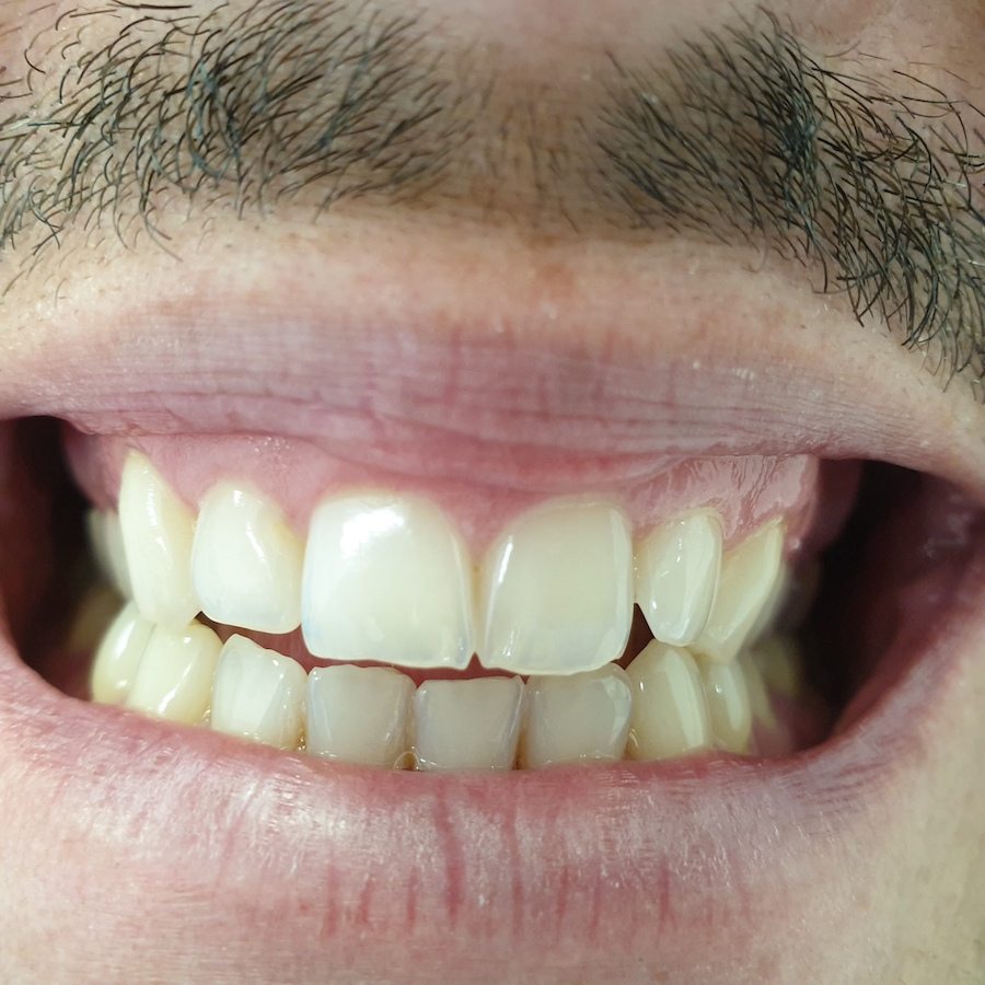 patient no.4: Teeth whitening-Before