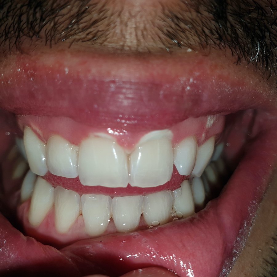 Pacijent br.4: Beljenje zuba-Posle