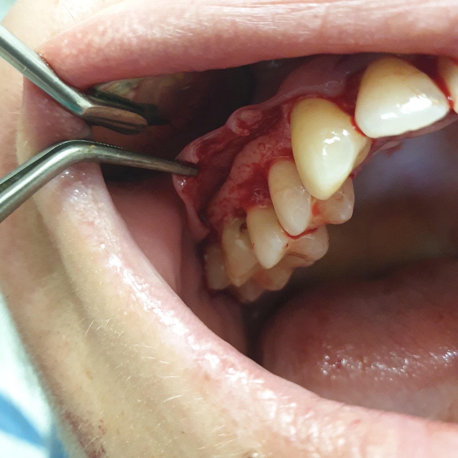 patient no.1: Lobe surgery-The course of gum lifting surgery