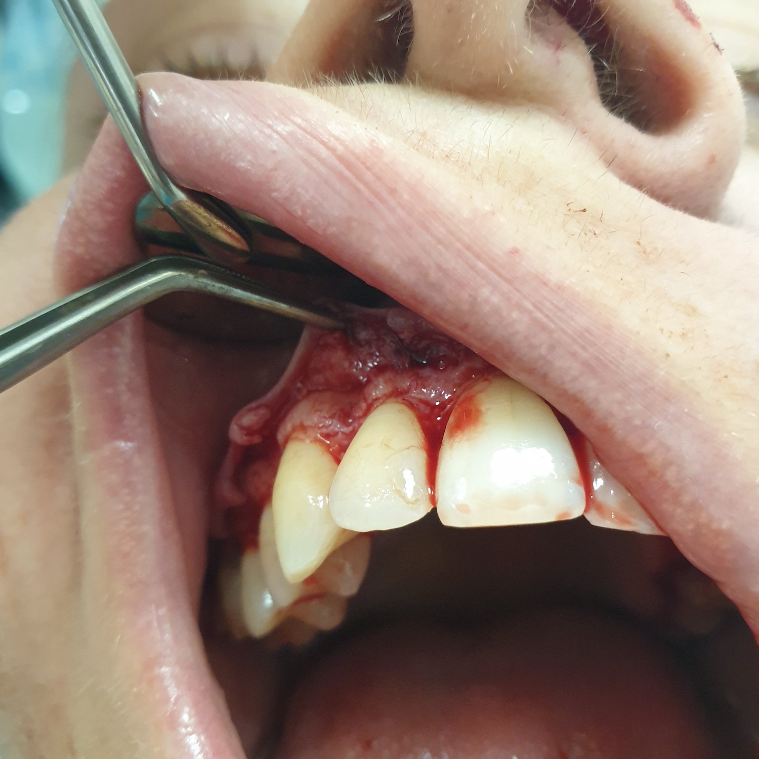 patient no.1: Lobe surgery-The course of gum lifting surgery