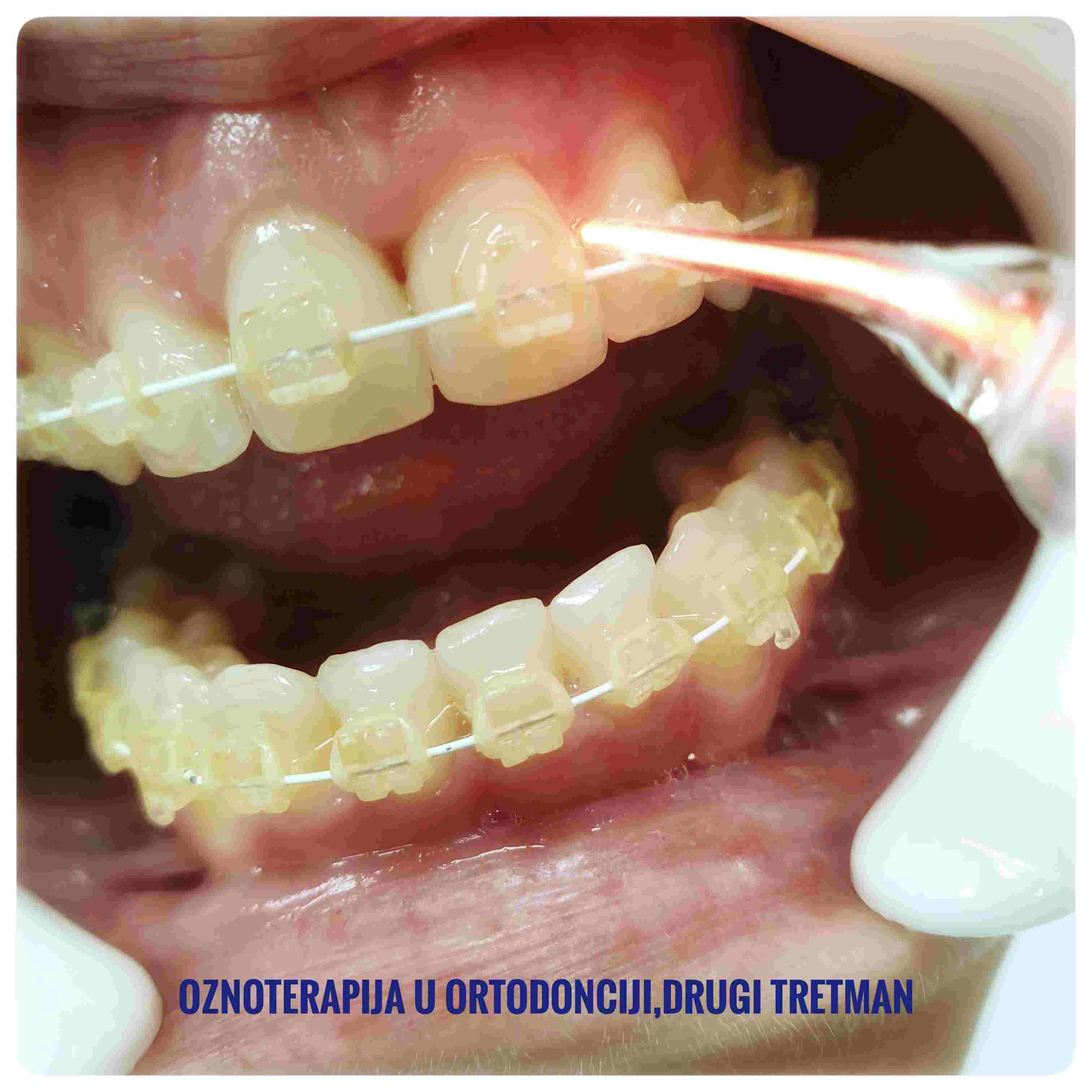 Ozonoterapija u ortodonciji