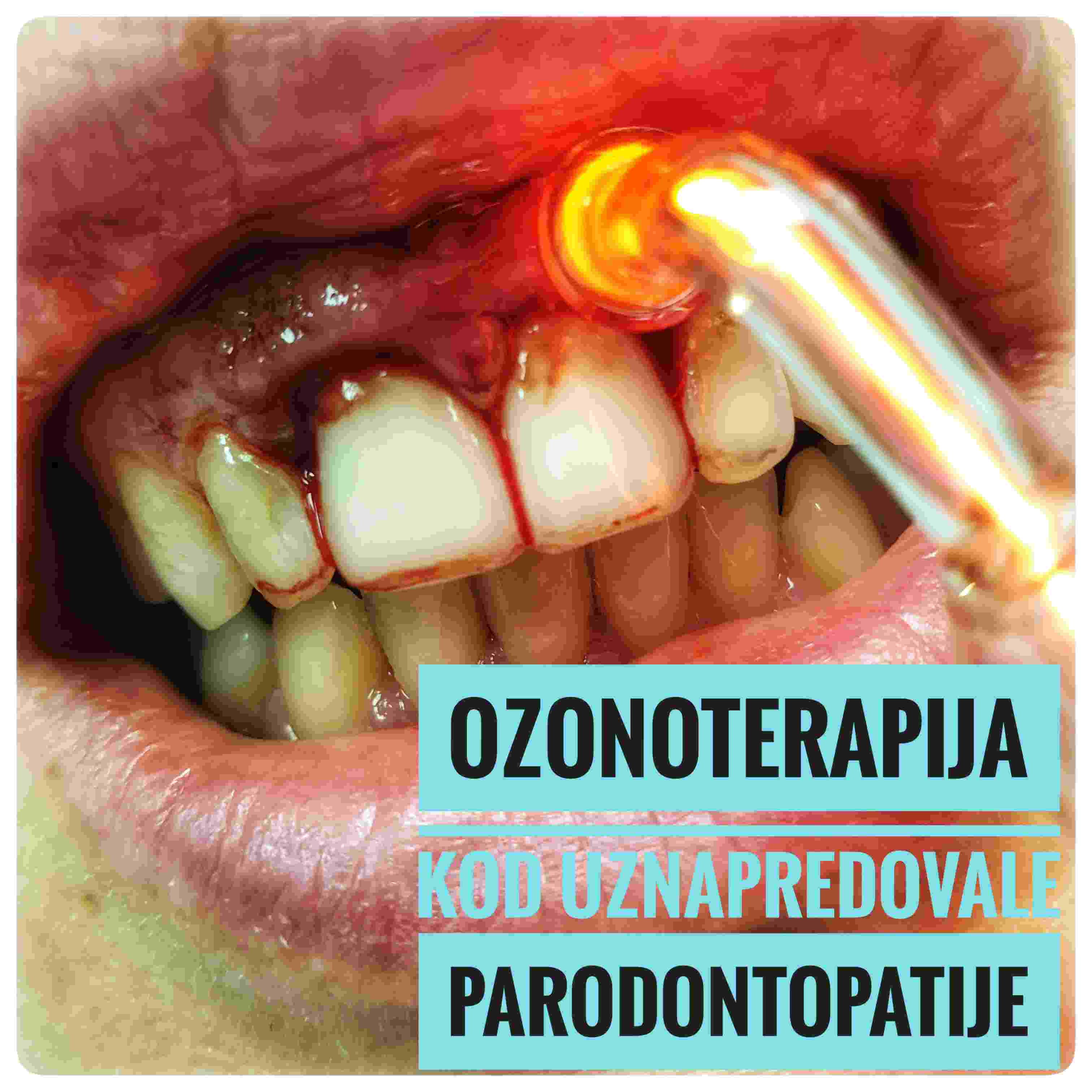 Ozonoterapija-uznapredovana parodontapija