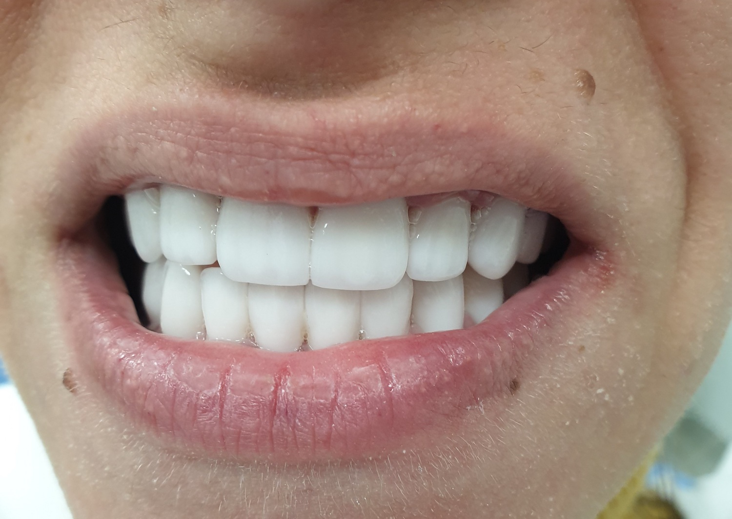 Patient No.1: Metal-free crowns-After