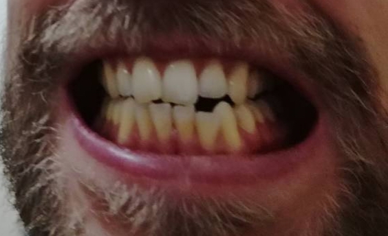 Pacijent br.2: Beljenje zuba-Pre