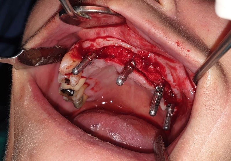Postavljanje 4 implanta u gornjoj vilici