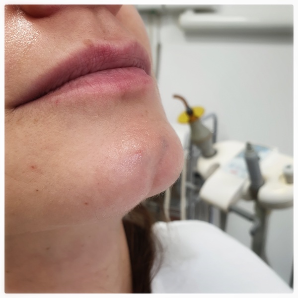 Filling up of chin hole – before 