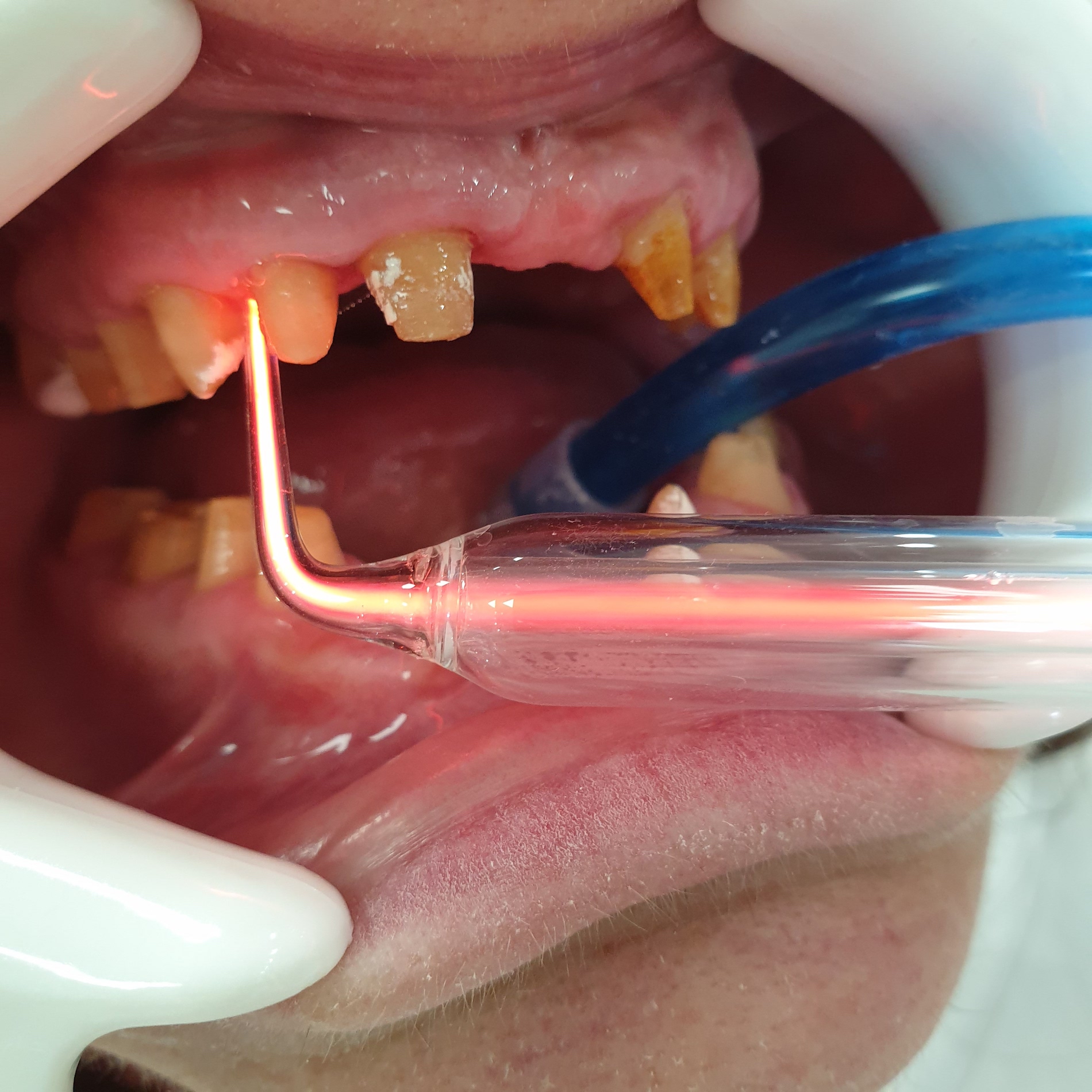 Pacijent br.1: Ozoniranje desni oko brušenih zuba-Pre