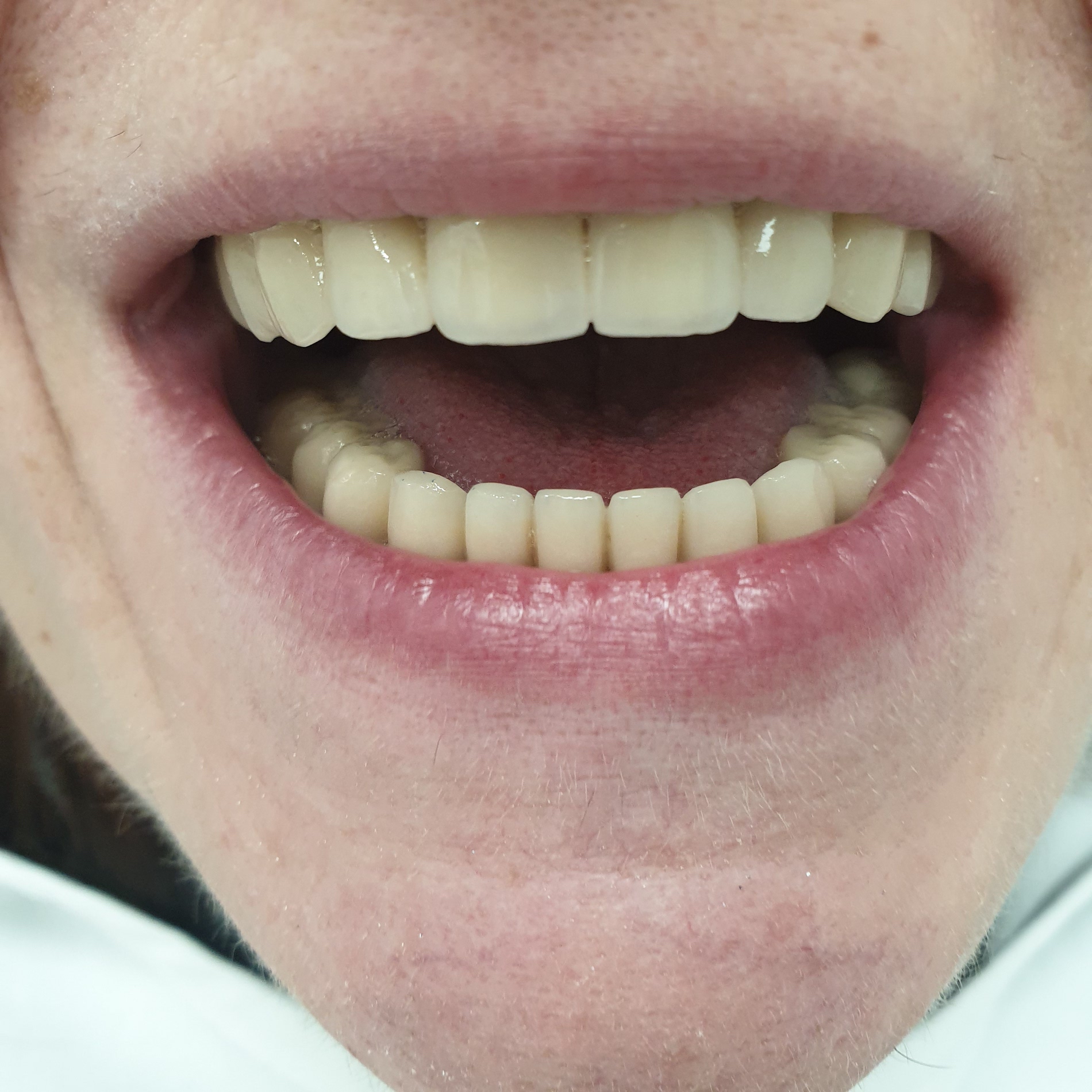 patient no.1: placement of metal-ceramic crowns-after