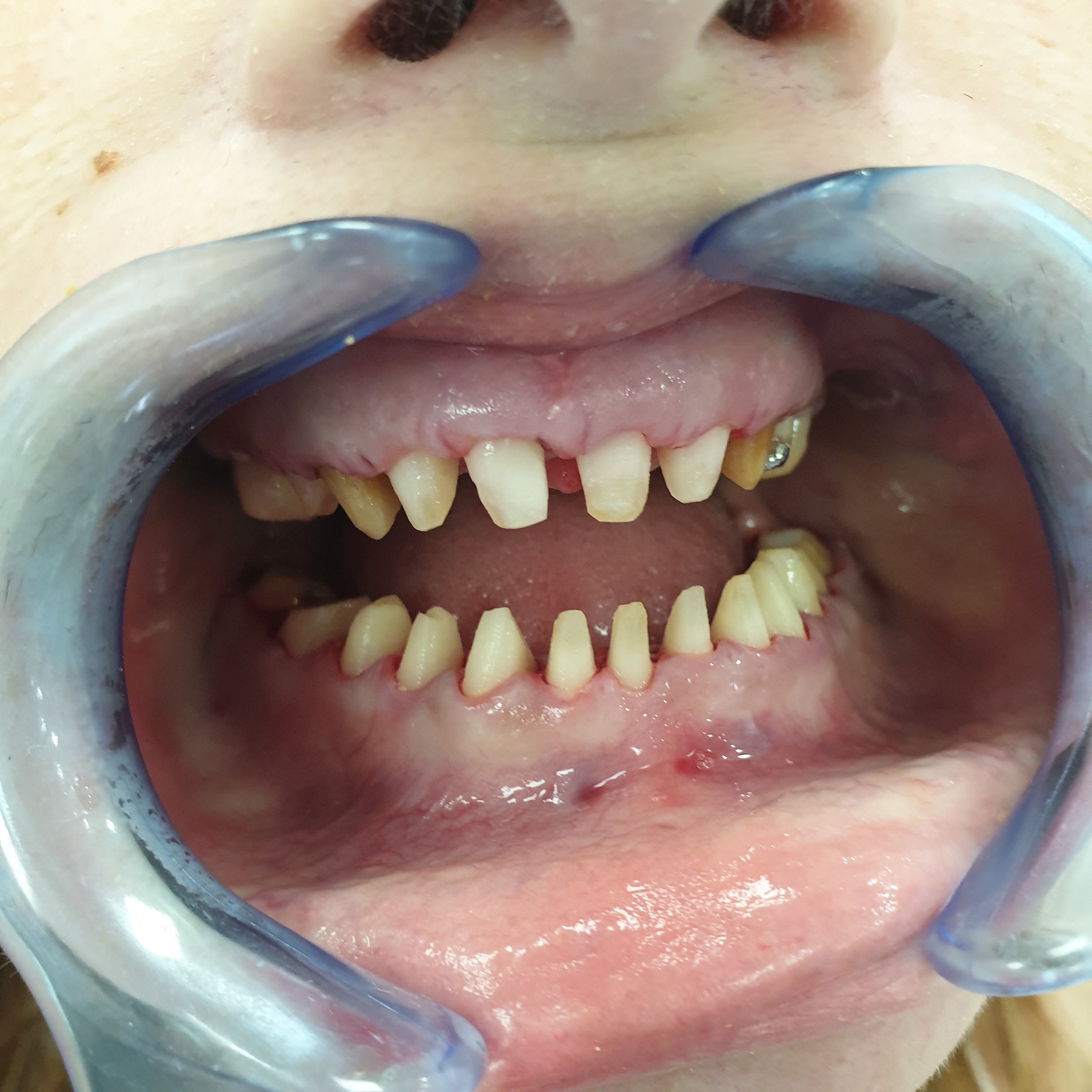 Pacijent br.1: Priprema za postavljanje metalokeramičkih krunica-izbrušeni zubi