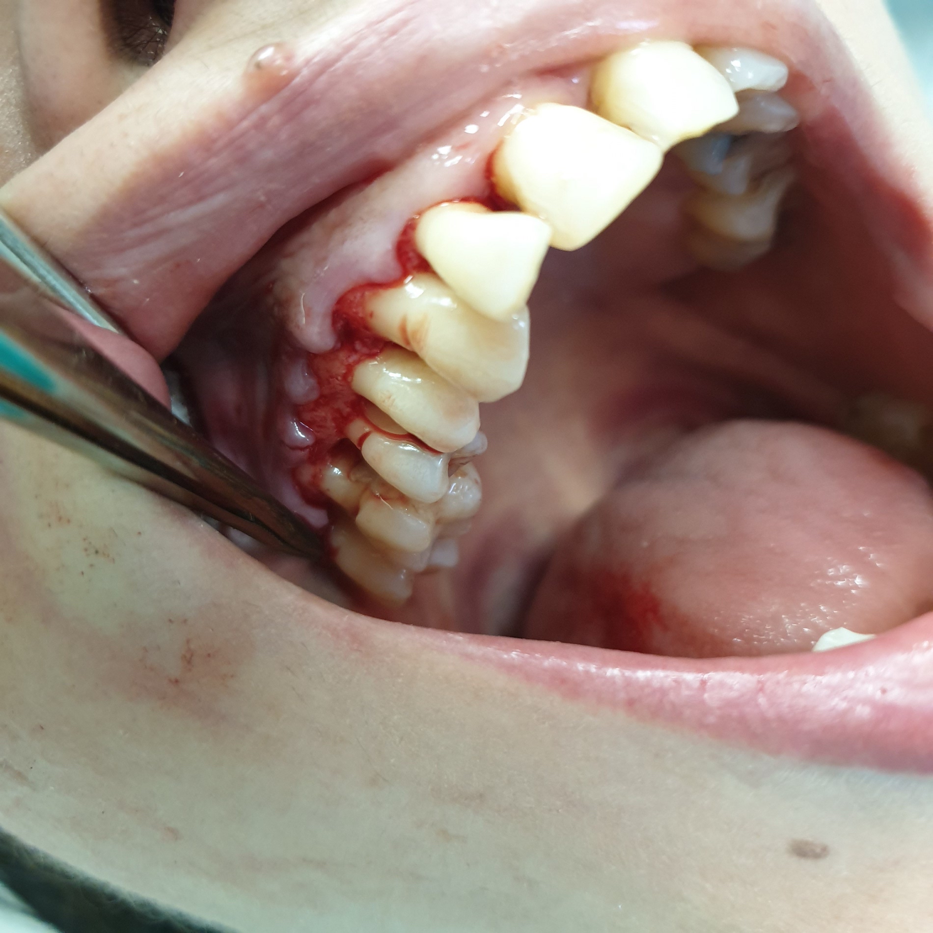 Pacijent br.2: režanj operacija-uklanjanje granulacija