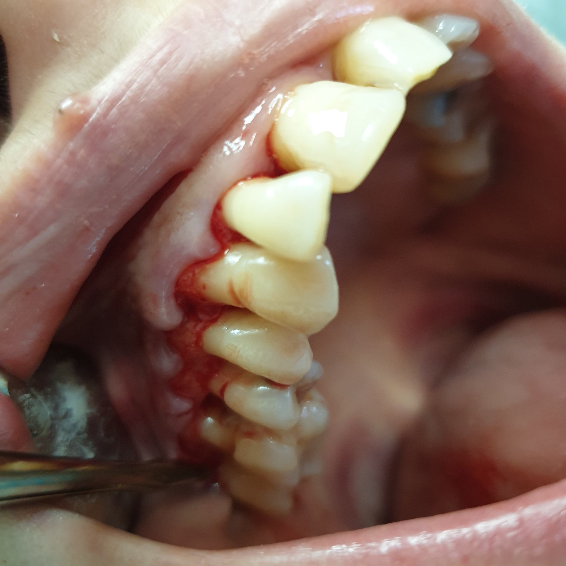 patient no.2: lobe surgery-lifting gums