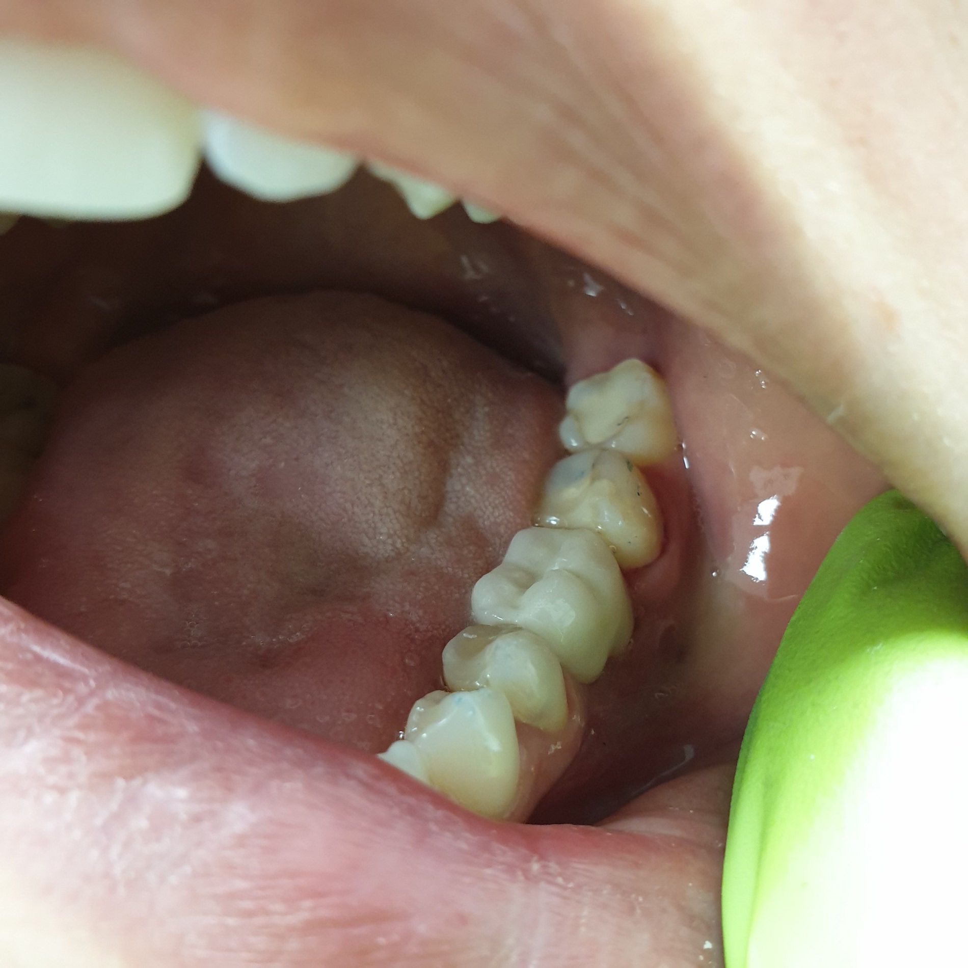 Pacijent br.1: Nadoknada jednog nedostajuceg zuba implantom-Posle