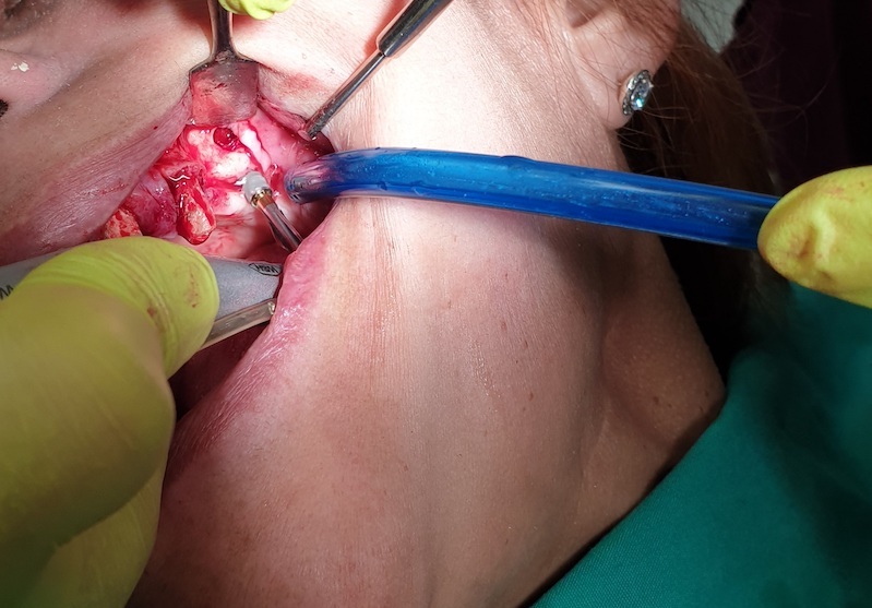 Positioning implants – quick and simple