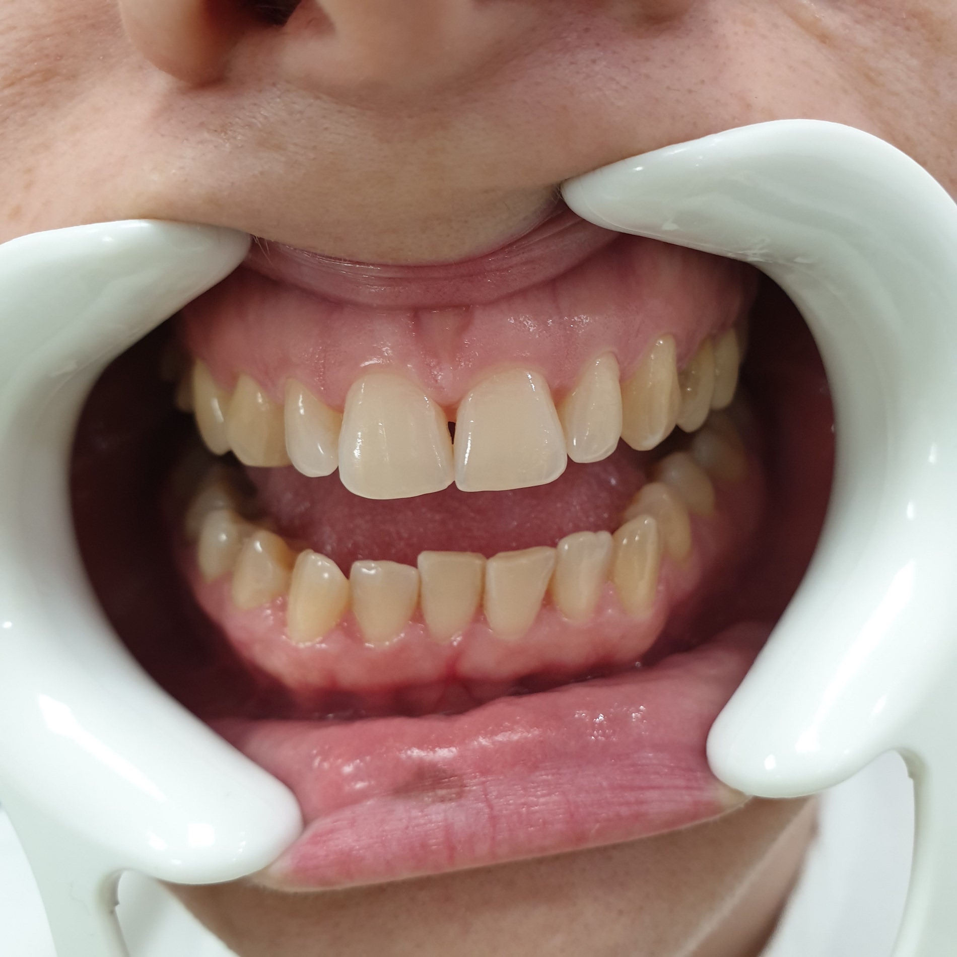 Pacijent br.1: Beljenje zuba-Pre