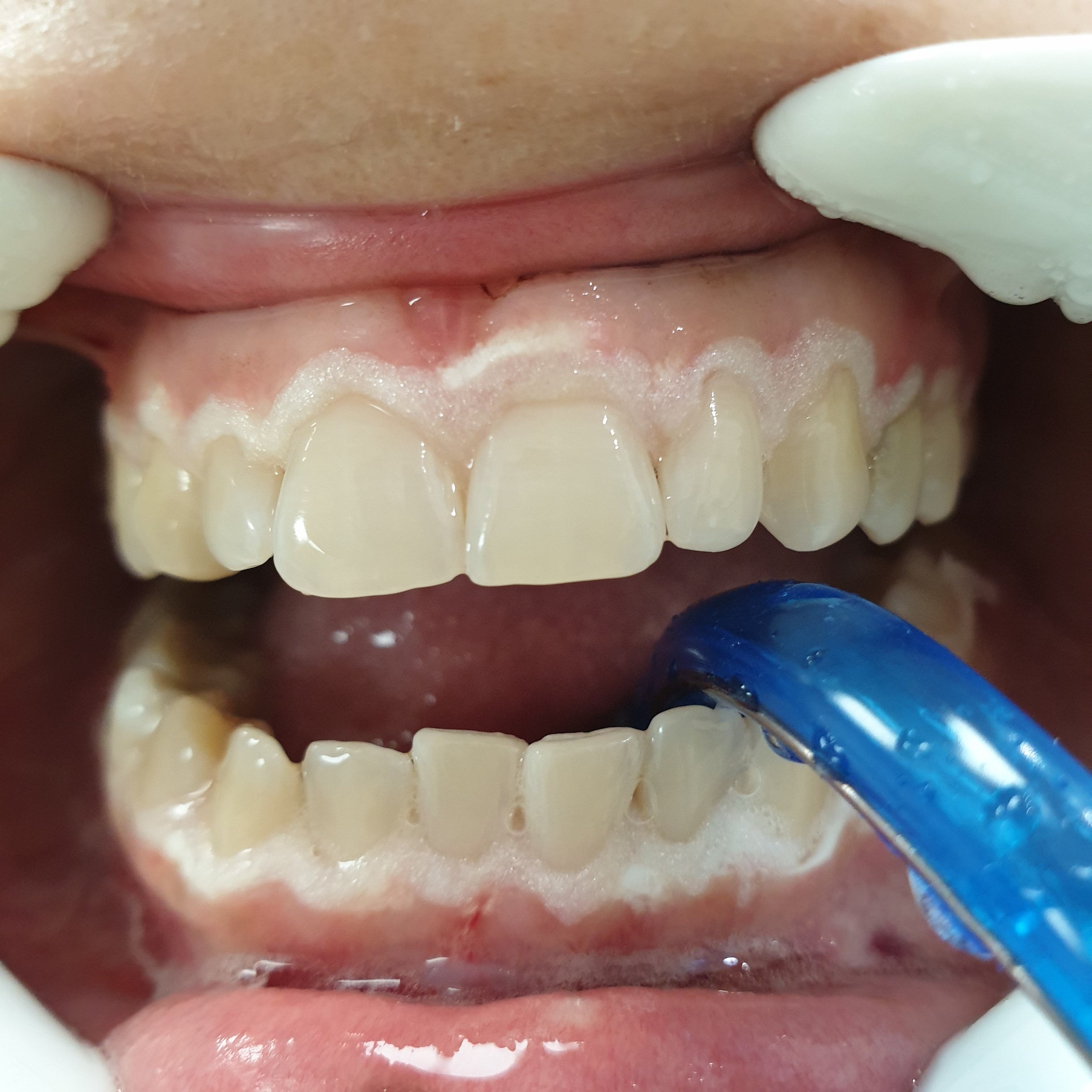 Pacijent br.1: Beljenje zuba-Posle