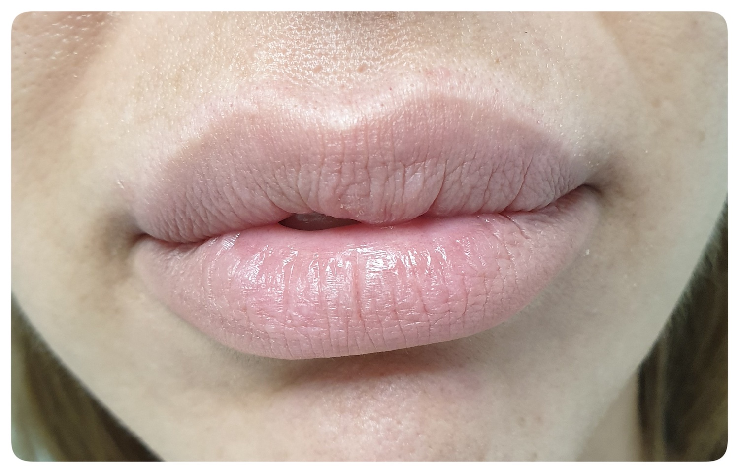 Pacijent br.1: Aplikovanje hijaluronskih filera u usne- Pre