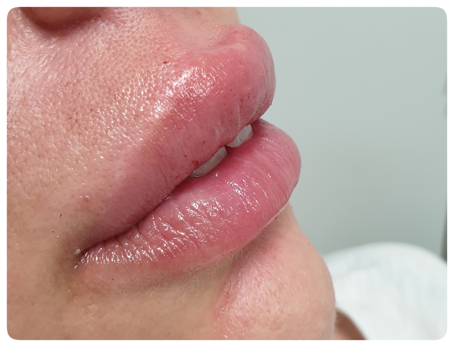Patient No.1: Lip application- After