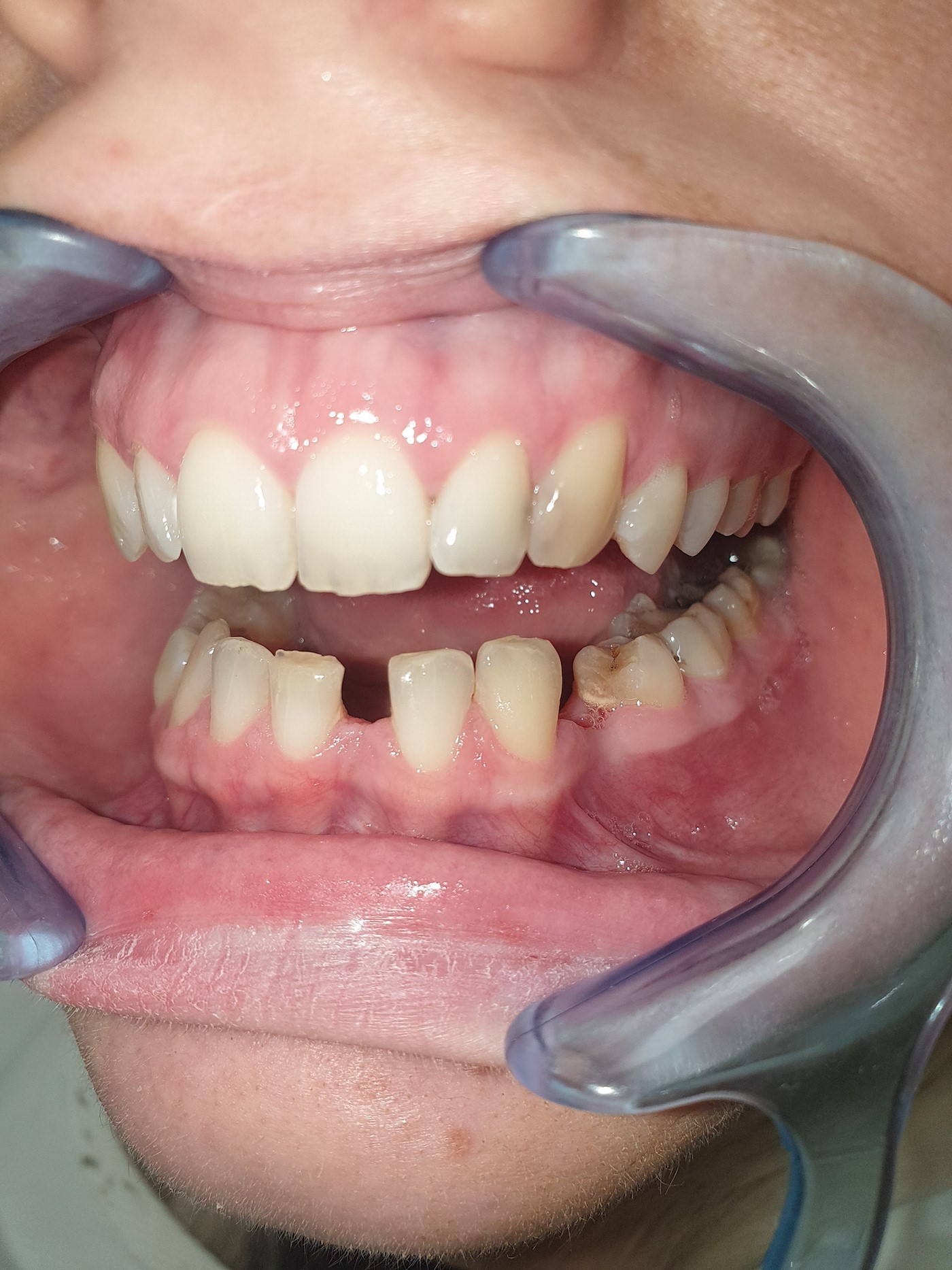 Patient No.1: Appearance of the jaw before placing the metal-ceramic crown