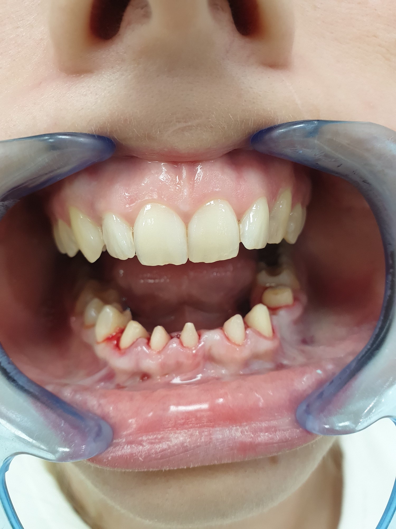 Patient No.1: Grinding teeth before placing a metal-ceramic crown