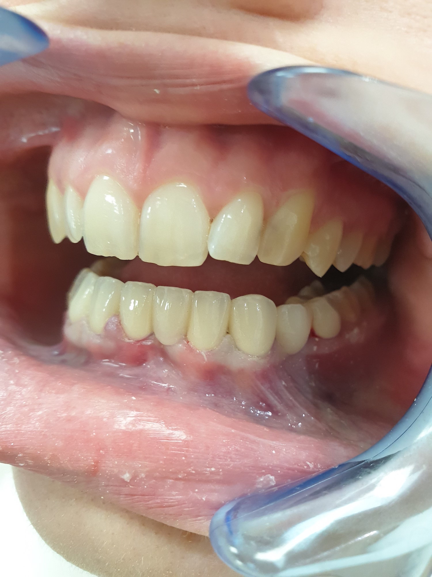 Patient No.1: Appearance after placement of a metal-ceramic crown