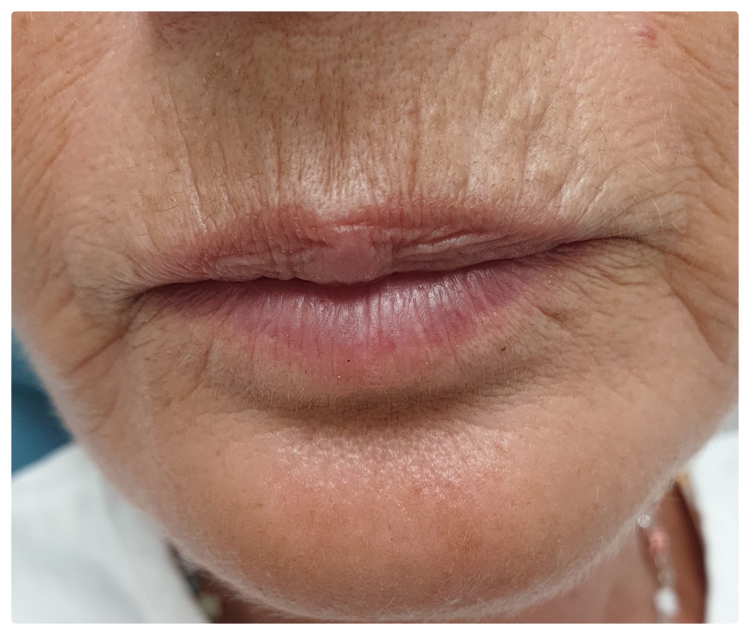 Patient No.1: Filling wrinkles around the lips-Before