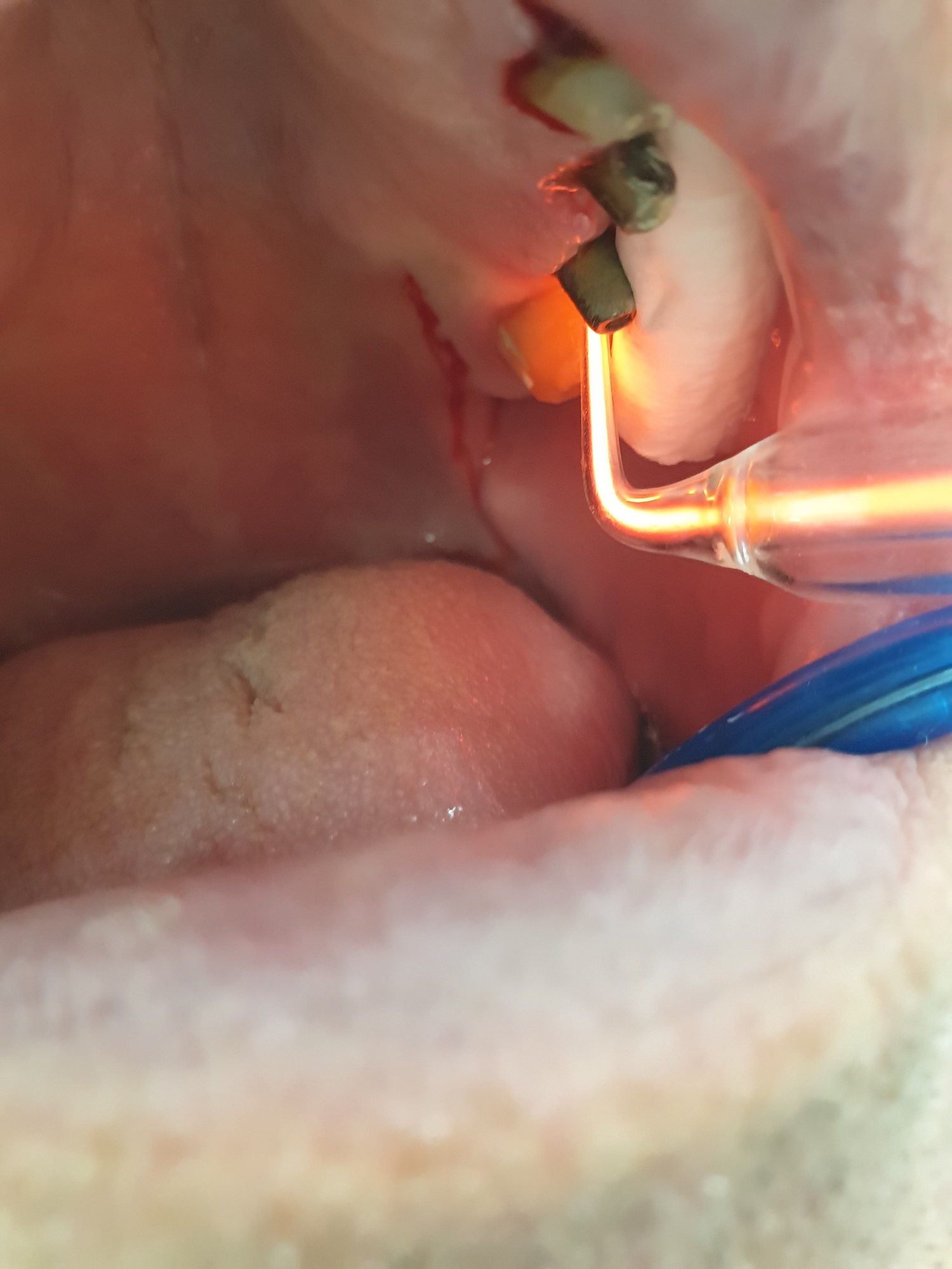 Pacijent br.1: Ozone therapy applied to implants and brushed teeth-Before