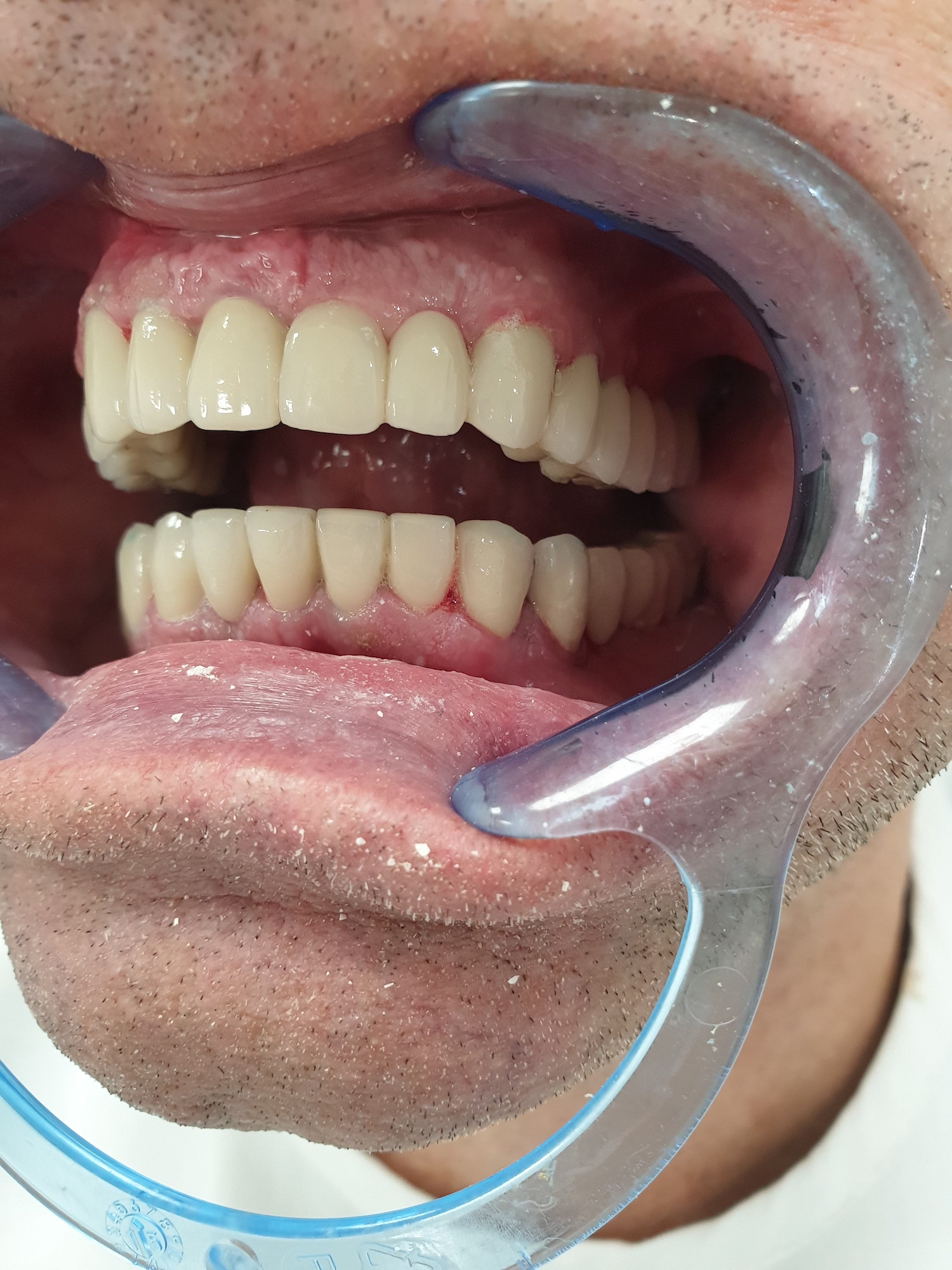 Pacijent br.1: Terapija ozonom primenjena na implantima i brušenim zubima-Posle