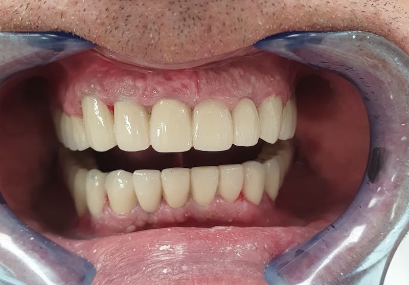  After - metalceramic crowns on teeth and implants