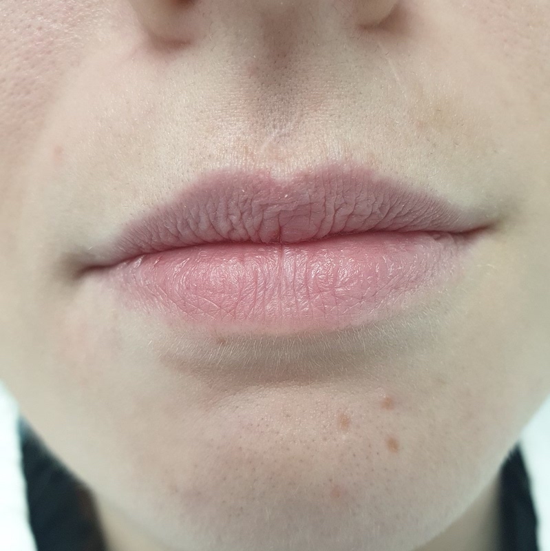 Application of hyaluronic fillers into lips 2 ml-Before
