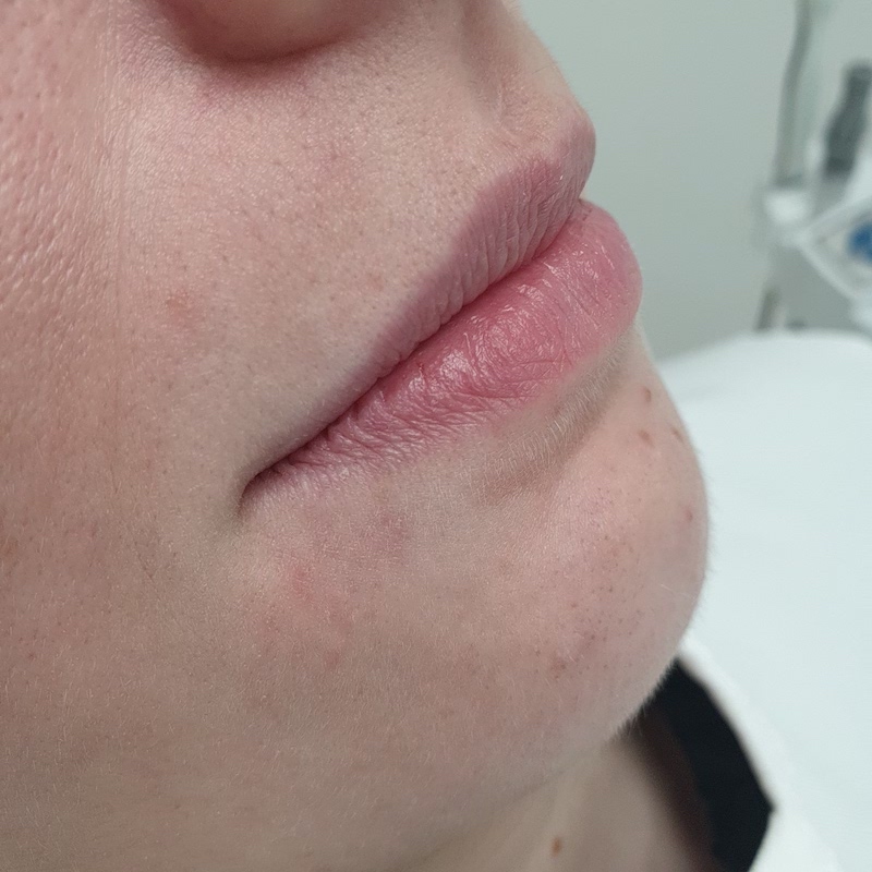 Application of hyaluronic fillers into lips 2,5 ml-Before
