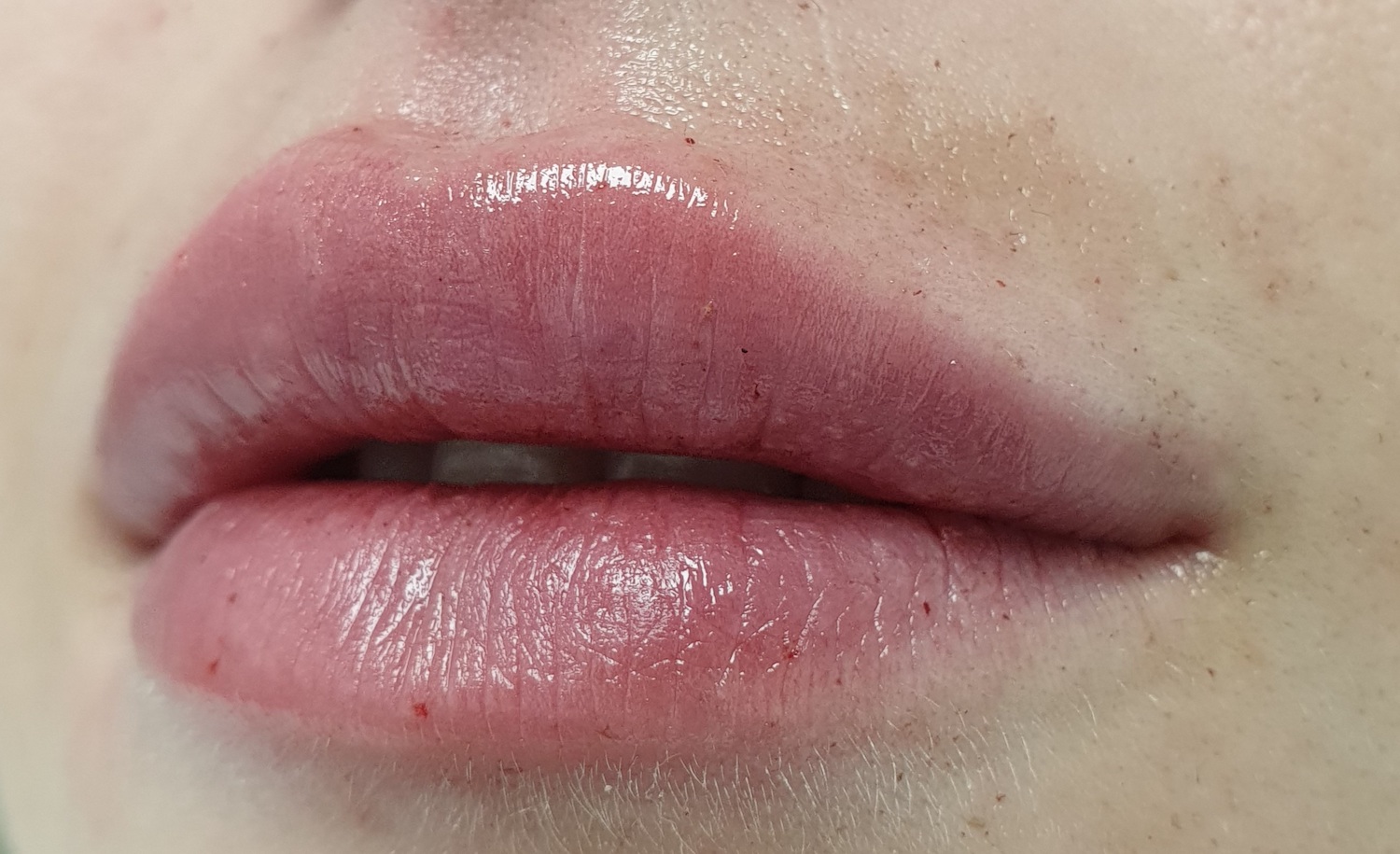 Patient No.2: Lip application