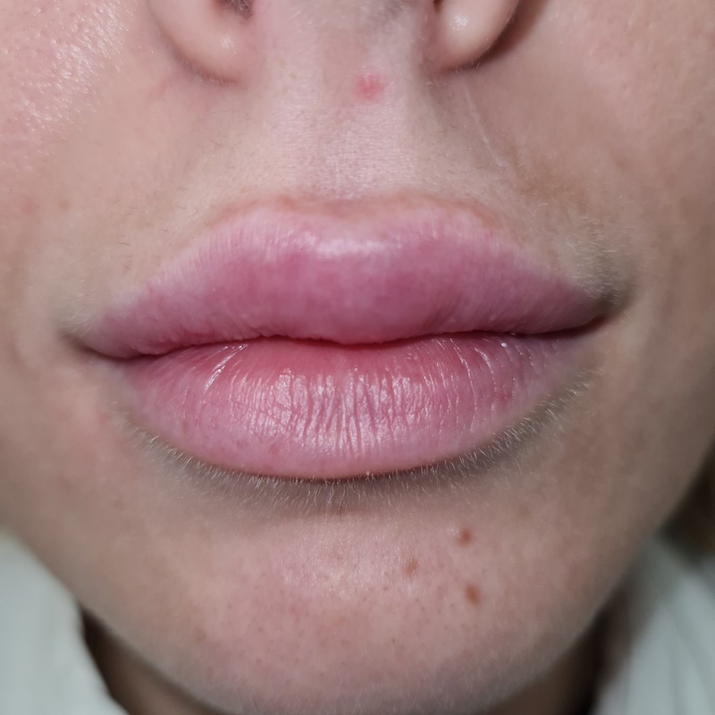 Application of hyaluronic fillers into lips 1 ml-After