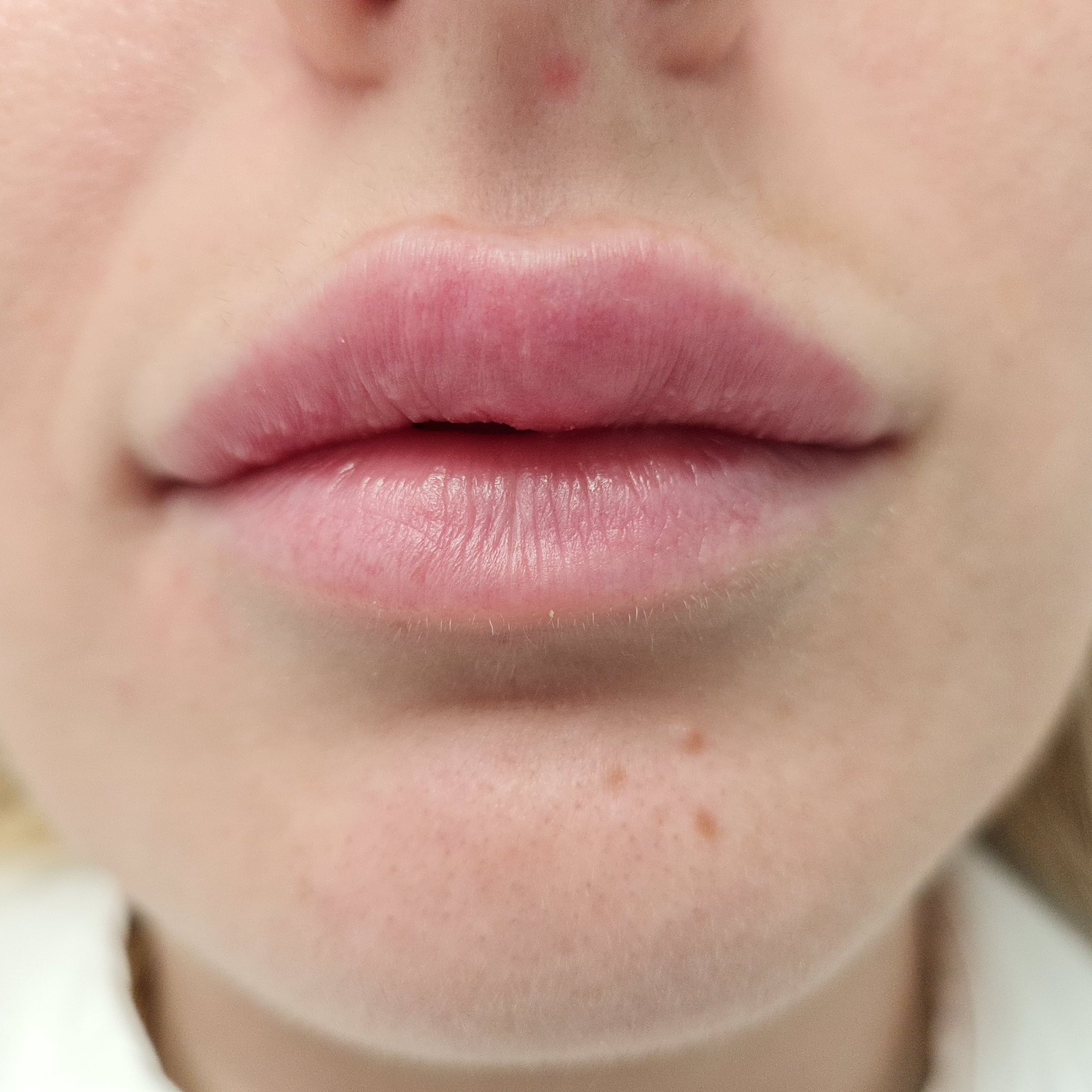 Patient No.1: Lip application-Before