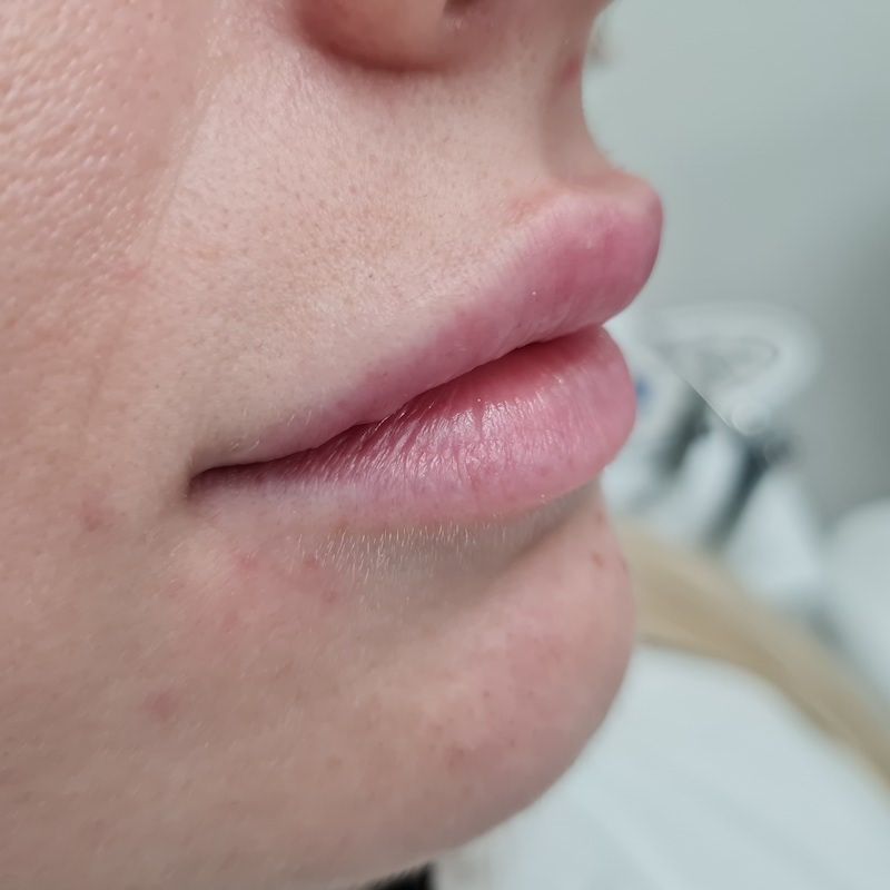 Application of hyaluronic fillers into lips 2 ml-Before
