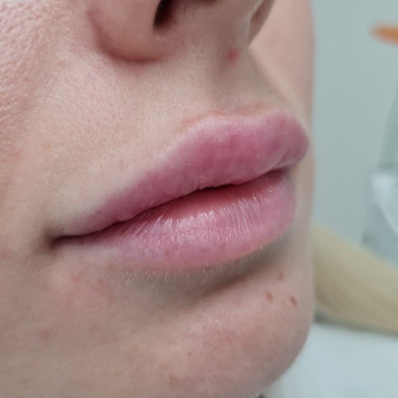 Application of hyaluronic fillers into lips 2 ml-After