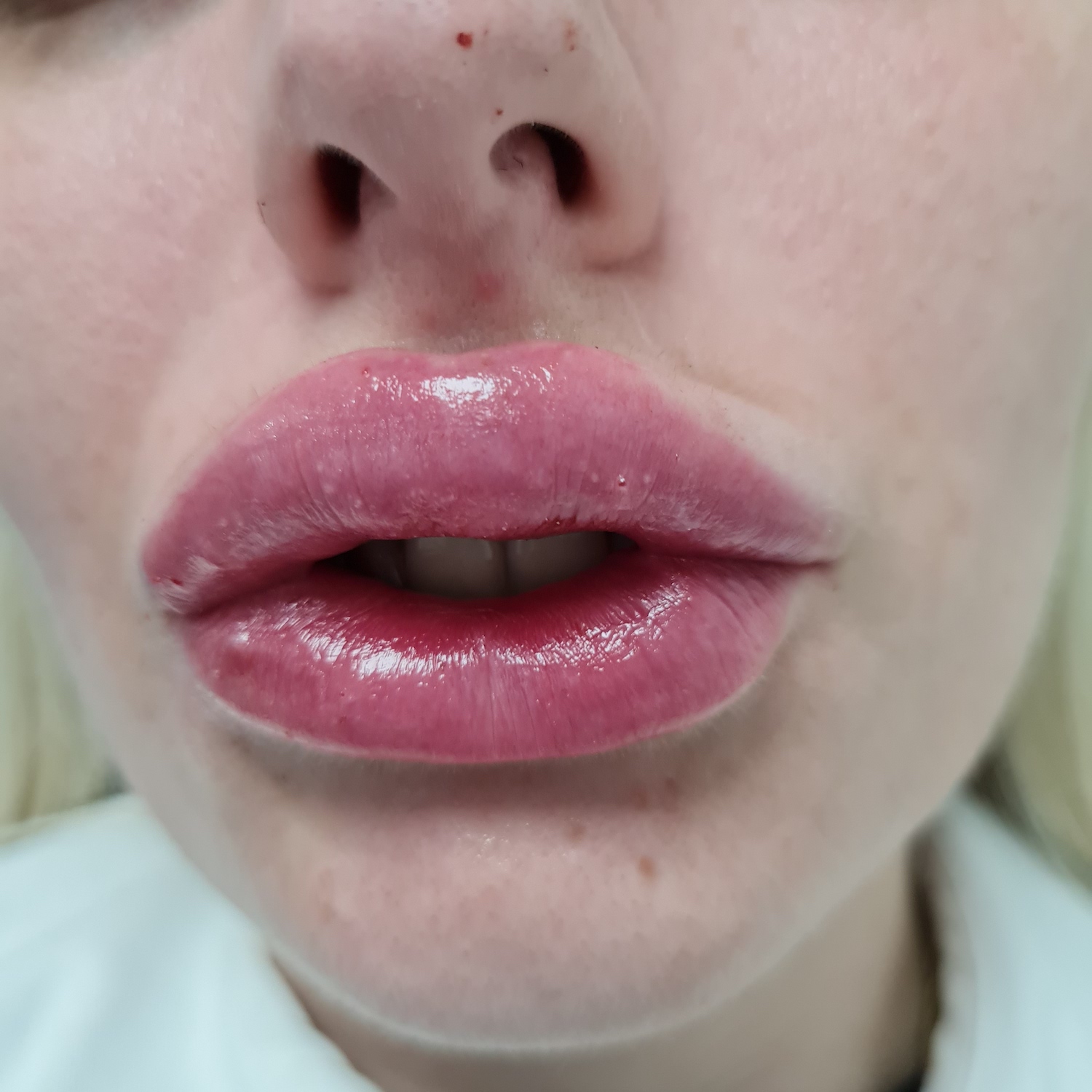 Patient No.1: Lip application