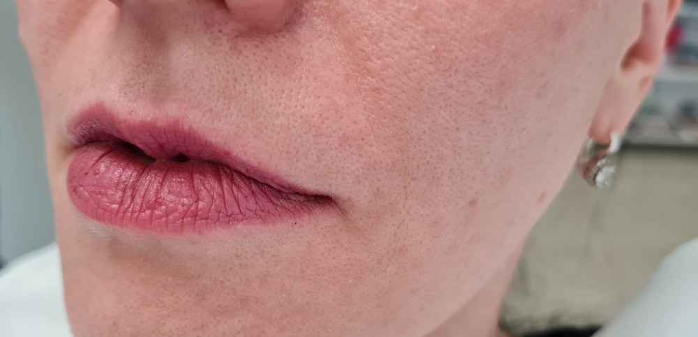 Pacijent br 1: Aplikovanje hijalurona u usne- Pre