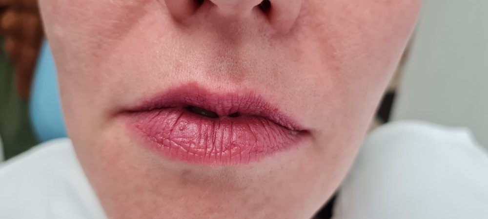 Patient No.3: Lip application-Before