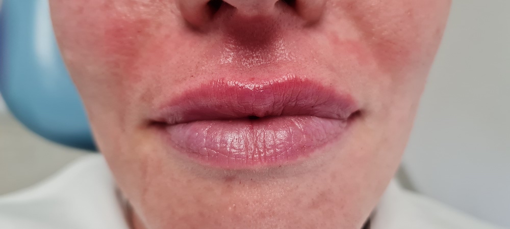 Patient No.3: Lip application-After