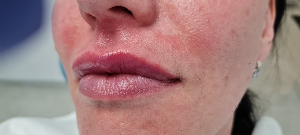 Pacijent br 1: Aplikovanje hijalurona u usne- Posle