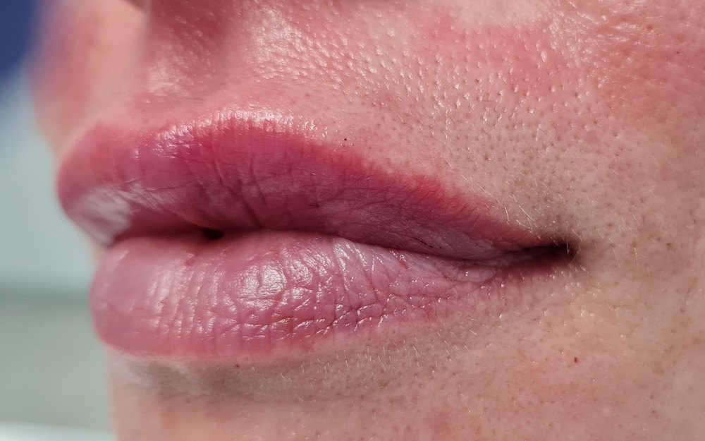 Pacijent br 1: Aplikovanje hijalurona u usne- Posle