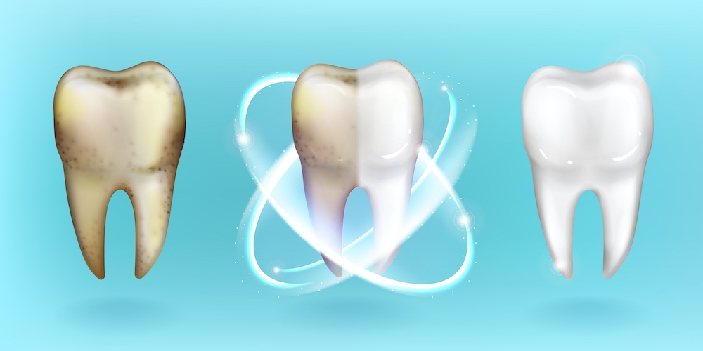 uzroci pogmentacije zuba