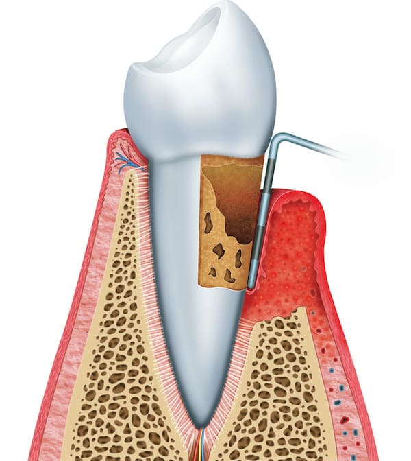 periodontal pocet