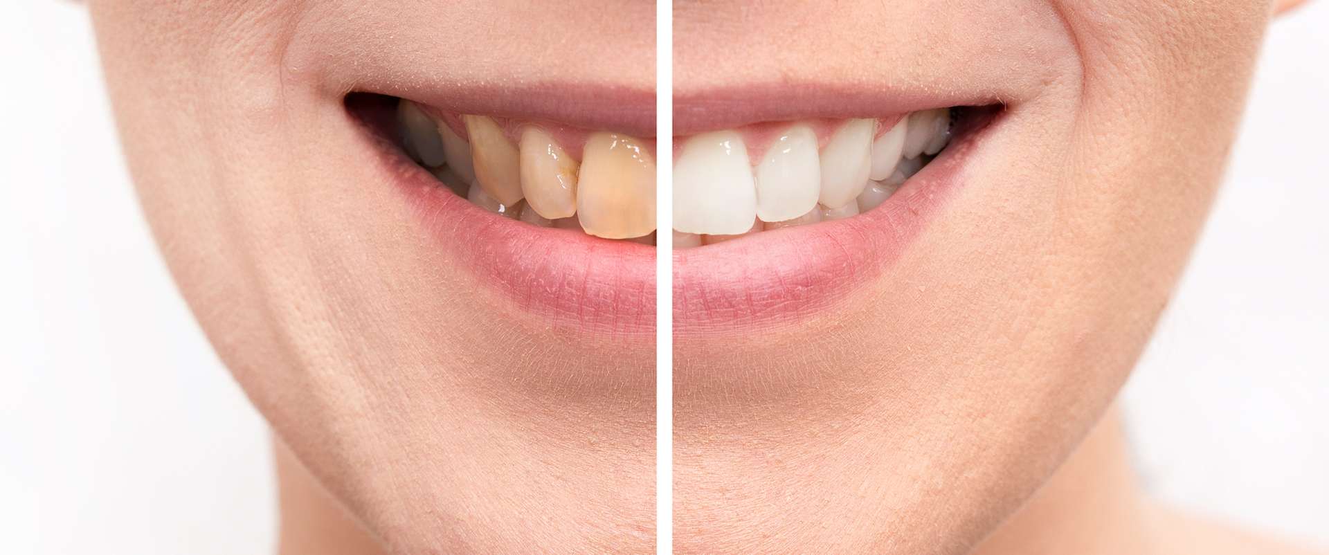 How tooth pigmentation affects the beauty of your smile and the change in tooth color